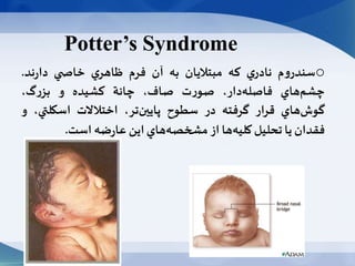 Potter’s Syndrome
o‫م‬‫و‬‫سندر‬‫ي‬‫نادر‬‫كه‬‫مبتاليان‬‫به‬‫آن‬‫فرم‬‫ي‬‫ظاهر‬‫ي‬ ‫خاص‬‫ند‬‫ر‬‫دا‬.
‫هاي‬‫چشم‬،‫دار‬‫فاصله‬‫ت‬‫ر‬‫صو‬،‫صاف‬‫چانة‬‫كشيده‬‫و‬،‫گ‬‫ر‬‫بز‬
‫هاي‬‫گوش‬‫قرار‬‫گرفته‬‫در‬‫سطوح‬،‫تر‬‫پايین‬‫اختالالت‬‫اسكلتي‬،‫و‬
‫فقدان‬‫يا‬‫تحليل‬‫ها‬‫كليه‬‫از‬‫هاي‬‫مشخصه‬‫اين‬‫ضه‬‫ر‬‫عا‬‫است‬.
 