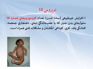 ‫مي‬‫و‬‫تريز‬18
o‫افزايش‬‫غیرطبيعي‬(‫تا‬‫سه‬‫شدن‬)‫تعداد‬‫هاي‬‫وم‬‫ز‬‫مو‬‫و‬‫كر‬‫ة‬‫ر‬‫شما‬18
‫هاي‬‫ل‬‫سلو‬‫بدن‬‫جنین‬‫كه‬‫با‬‫ماندگي‬‫عقب‬،‫ذهني‬‫ي‬‫ناهنجار‬‫جمجم‬،‫ه‬
‫افتادگي‬،‫پلك‬،‫ي‬‫كر‬‫كوتاهي‬‫انگشتان‬‫و‬‫مشكالت‬‫قلبي‬‫همر‬‫اه‬‫است‬.
 