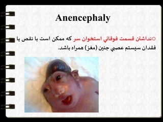 Anencephaly
o‫نداشتن‬‫قسمت‬‫فوقاني‬‫استخوان‬‫سر‬‫كه‬‫ممكن‬‫است‬‫با‬‫نقص‬‫يا‬
‫فقدان‬‫سيستم‬‫عصبي‬‫جنین‬(‫مغز‬)‫همراه‬‫باشد‬.
 