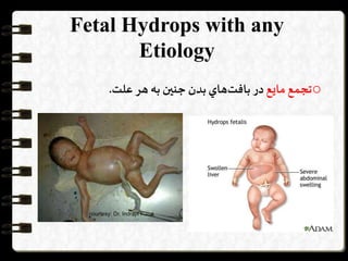 Fetal Hydrops with any
Etiology
o‫تجمع‬‫مايع‬‫در‬‫هاي‬‫بافت‬‫بدن‬‫جنین‬‫به‬‫هر‬‫علت‬.
 