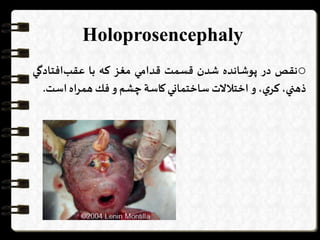 Holoprosencephaly
o‫نقص‬‫در‬‫پوشانده‬‫شدن‬‫قسمت‬‫قدامي‬‫مغز‬‫كه‬‫با‬‫افتادگ‬‫عقب‬‫ي‬
،‫ذهني‬،‫ي‬‫كر‬‫و‬‫اختالالت‬‫ساختماني‬‫كاسة‬‫چشم‬‫و‬‫فك‬‫همراه‬‫است‬.
 