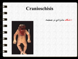 Cranioschisis
o‫شكاف‬‫ادي‬‫ز‬‫مادر‬‫در‬‫جمجمه‬.
 