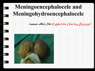 Meningoencephalocele and
Meningohydroencephalocele
o‫دگي‬‫ز‬‫بیرون‬‫پردة‬‫مننژ‬‫و‬‫مادة‬‫ي‬‫مغز‬‫از‬‫خالل‬‫شكاف‬‫جمجمه‬.
 