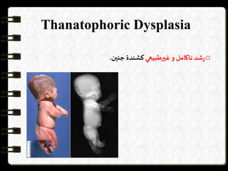 Thanatophoric Dysplasia
o‫شد‬‫ر‬‫ناكامل‬‫و‬‫غیرطبيعي‬‫كشندة‬‫جنین‬.
 