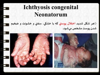 Ichthyosis congenital
Neonatorum
o‫هر‬‫شكل‬‫شديد‬‫اختالل‬‫پوستي‬‫كه‬‫با‬،‫خشكي‬‫سفتي‬‫و‬‫خشونت‬‫و‬‫ضخ‬‫يم‬
‫شدن‬‫پوست‬‫مشخص‬‫شود‬‫مي‬.
 