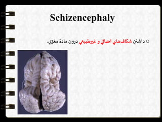 Schizencephaly
o‫داشتن‬‫هاي‬‫شكاف‬‫اضافي‬‫و‬‫غیرطبيعي‬‫ن‬‫و‬‫در‬‫مادة‬‫ي‬‫مغز‬.
 