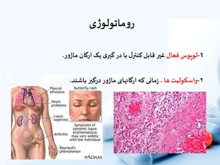 ‫ی‬‫ژ‬‫ماتولو‬‫و‬‫ر‬
1-‫لوپوس‬‫فعال‬‫غیر‬‫قابل‬‫ل‬‫کنتر‬‫با‬‫در‬‫ى‬‫گیر‬‫یک‬‫ارگان‬‫ر‬‫و‬‫ماژ‬.
۲-‫واسکولیت‬‫ها‬،‫مانى‬‫ز‬‫که‬‫ارگانهاى‬‫ر‬‫و‬‫ماژ‬‫درگیر‬‫باشند‬.
 