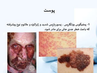 ‫پوست‬
1-‫پمفیگوس‬‫یس‬‫ر‬‫لگا‬‫و‬‫و‬،‫یس‬‫ز‬‫یا‬‫ر‬‫پسو‬‫شدید‬‫و‬‫الیزه‬‫ر‬‫ن‬‫ژ‬‫و‬‫مالنوم‬‫نوع‬‫پیشرفته‬
‫که‬‫باعث‬‫خطر‬‫جدى‬‫جانى‬‫براى‬‫مادر‬‫شود‬.
 