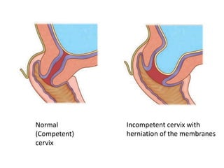 Normal
(Competent)
cervix
Incompetent cervix with
herniation of the membranes
 
