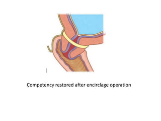 Competency restored after encirclage operation
 
