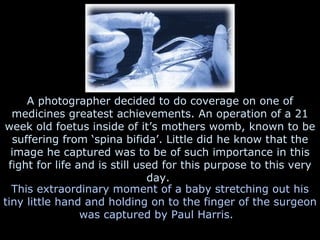 A photographer decided to do coverage on one of medicines greatest achievements. An operation of a 21 week old foetus insi...