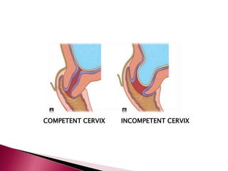 COMPETENT CERVIX INCOMPETENT CERVIX
 