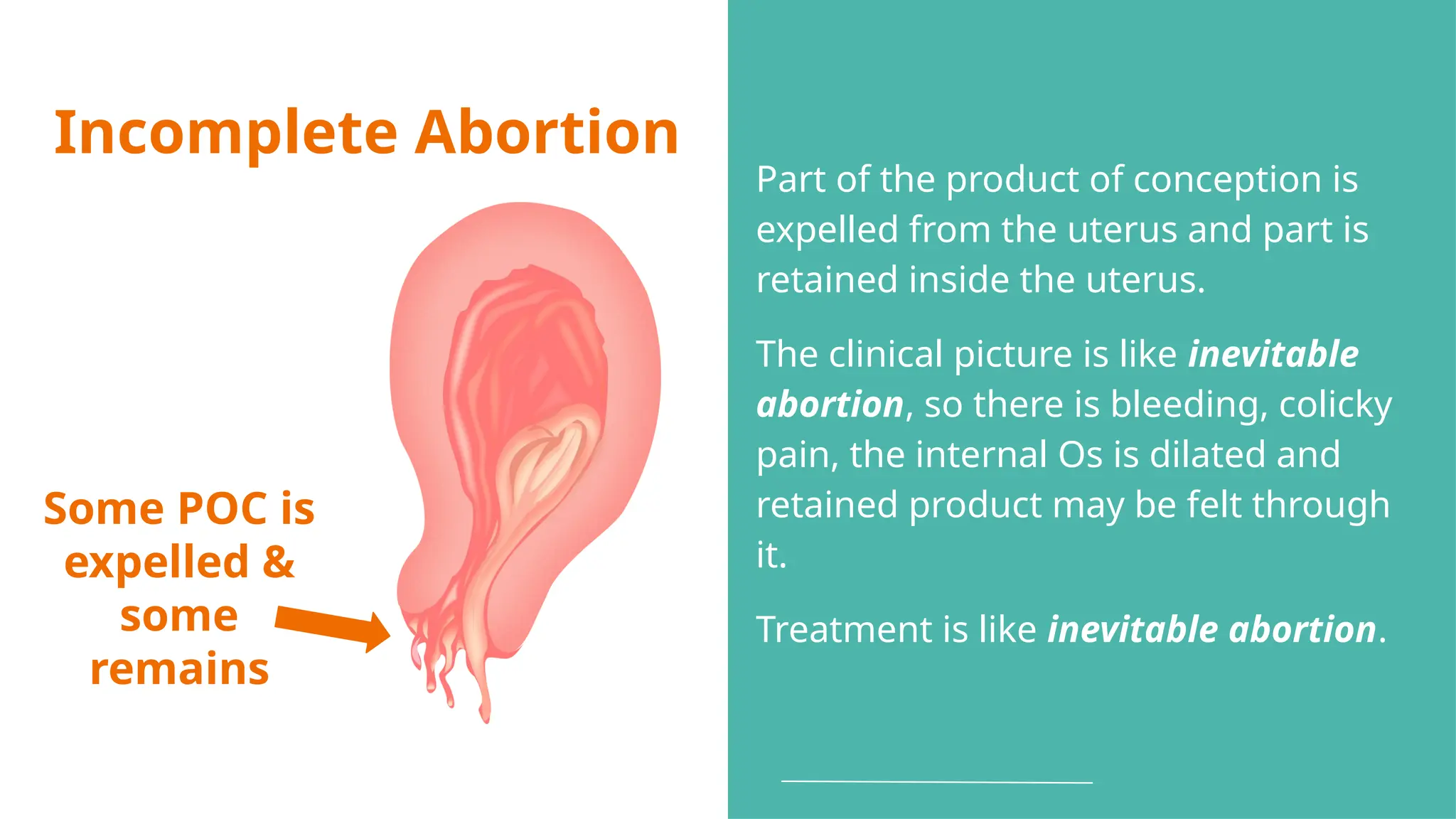 Incomplete Abortion
Some POC is
expelled &
some
remains
Part of the product of conception is
expelled from the uterus and part is
retained inside the uterus.
The clinical picture is like inevitable
abortion, so there is bleeding, colicky
pain, the internal Os is dilated and
retained product may be felt through
it.
Treatment is like inevitable abortion.
 