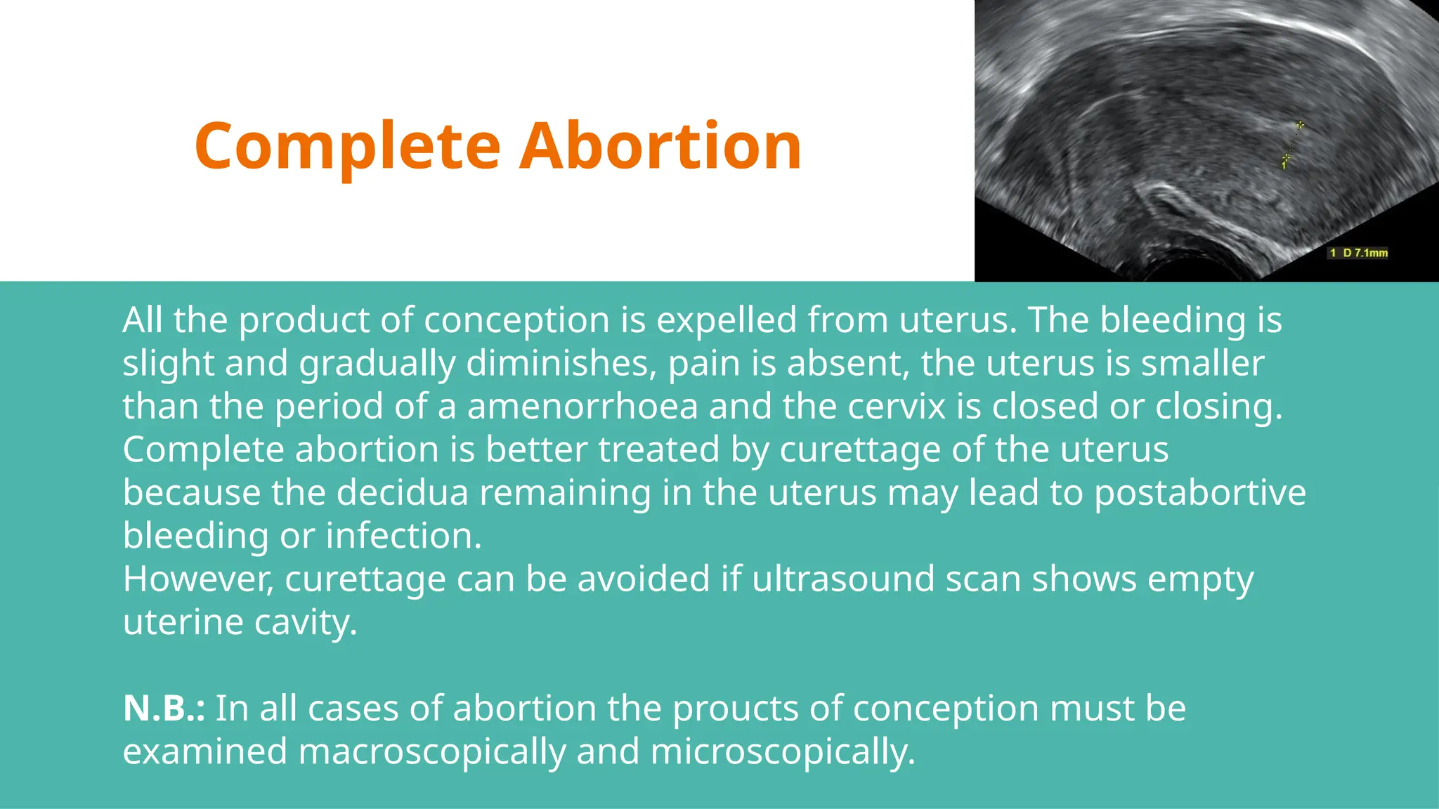 Complete Abortion
All the product of conception is expelled from uterus. The bleeding is
slight and gradually diminishes, pain is absent, the uterus is smaller
than the period of a amenorrhoea and the cervix is closed or closing.
Complete abortion is better treated by curettage of the uterus
because the decidua remaining in the uterus may lead to postabortive
bleeding or infection.
However, curettage can be avoided if ultrasound scan shows empty
uterine cavity.
N.B.: In all cases of abortion the proucts of conception must be
examined macroscopically and microscopically.
 