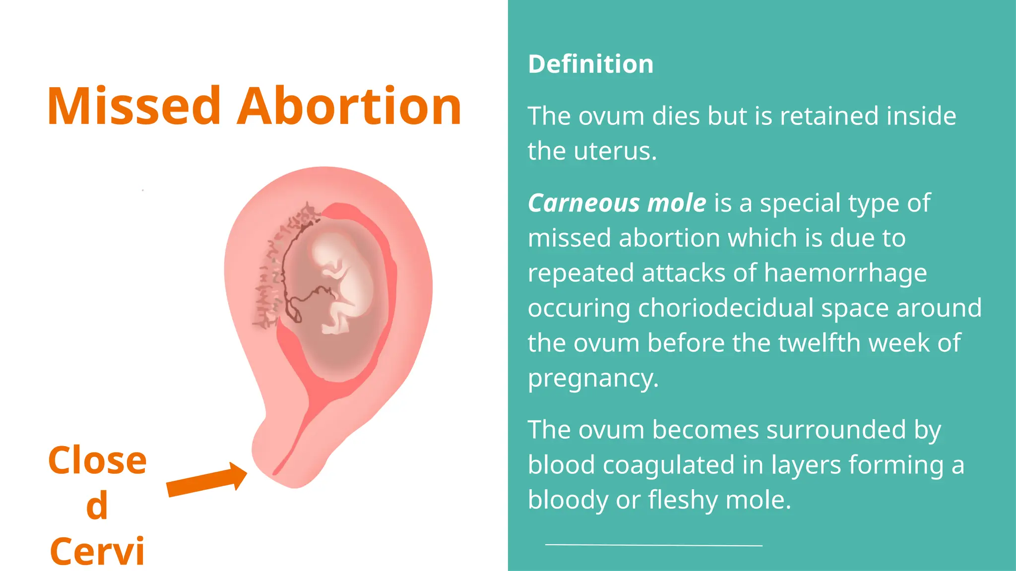 Missed Abortion
Close
d
Cervi
Definition
The ovum dies but is retained inside
the uterus.
Carneous mole is a special type of
missed abortion which is due to
repeated attacks of haemorrhage
occuring choriodecidual space around
the ovum before the twelfth week of
pregnancy.
The ovum becomes surrounded by
blood coagulated in layers forming a
bloody or fleshy mole.
 