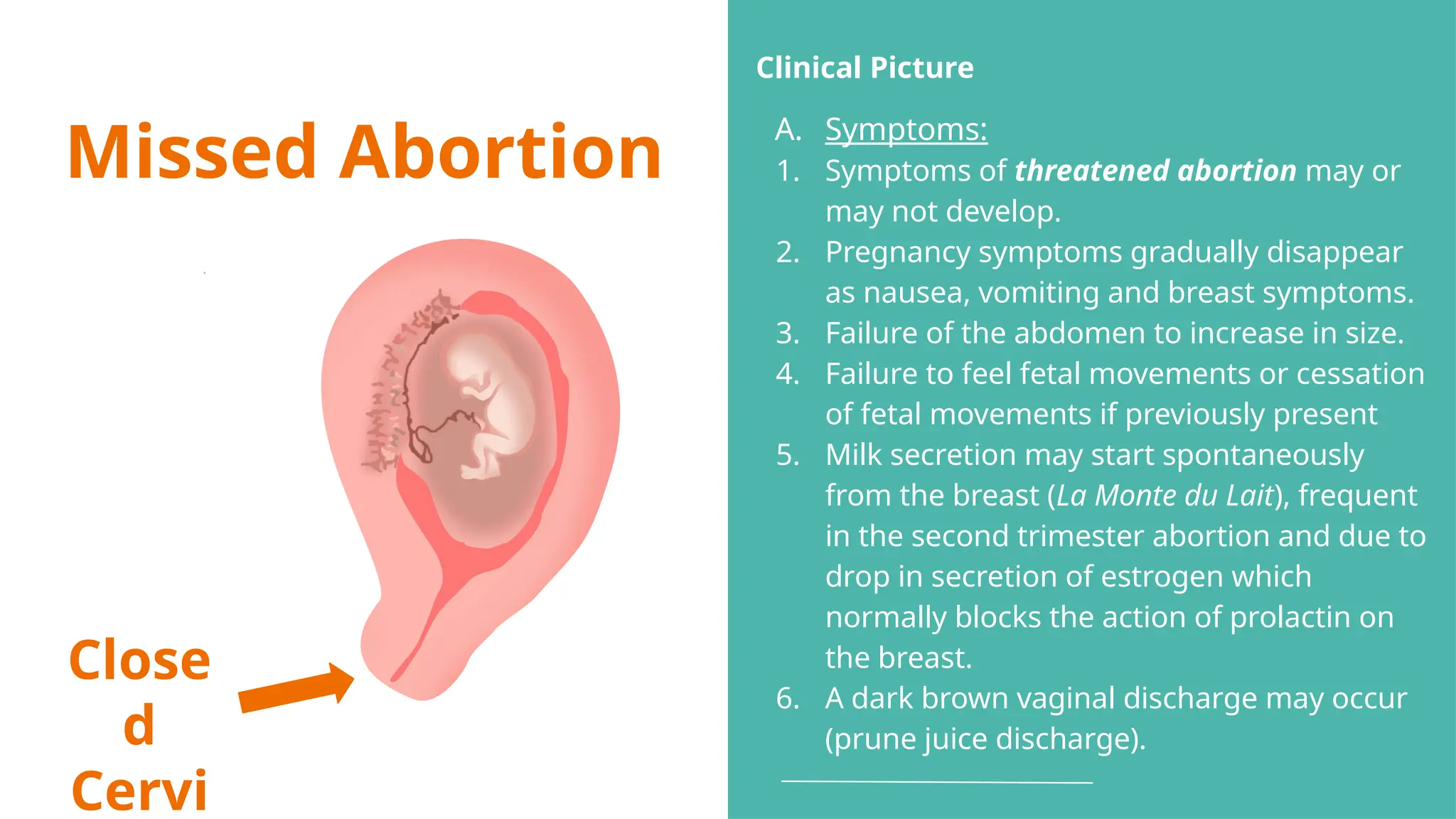 Missed Abortion
Close
d
Cervi
Clinical Picture
A. Symptoms:
1. Symptoms of threatened abortion may or
may not develop.
2. Pregnancy symptoms gradually disappear
as nausea, vomiting and breast symptoms.
3. Failure of the abdomen to increase in size.
4. Failure to feel fetal movements or cessation
of fetal movements if previously present
5. Milk secretion may start spontaneously
from the breast (La Monte du Lait), frequent
in the second trimester abortion and due to
drop in secretion of estrogen which
normally blocks the action of prolactin on
the breast.
6. A dark brown vaginal discharge may occur
(prune juice discharge).
 