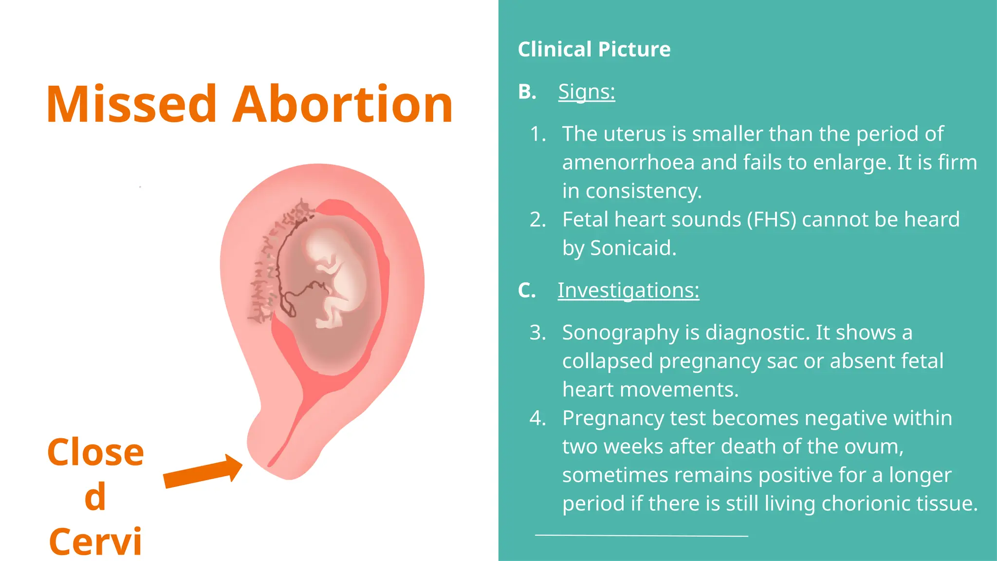 Missed Abortion
Close
d
Cervi
Clinical Picture
B. Signs:
1. The uterus is smaller than the period of
amenorrhoea and fails to enlarge. It is firm
in consistency.
2. Fetal heart sounds (FHS) cannot be heard
by Sonicaid.
C. Investigations:
3. Sonography is diagnostic. It shows a
collapsed pregnancy sac or absent fetal
heart movements.
4. Pregnancy test becomes negative within
two weeks after death of the ovum,
sometimes remains positive for a longer
period if there is still living chorionic tissue.
 