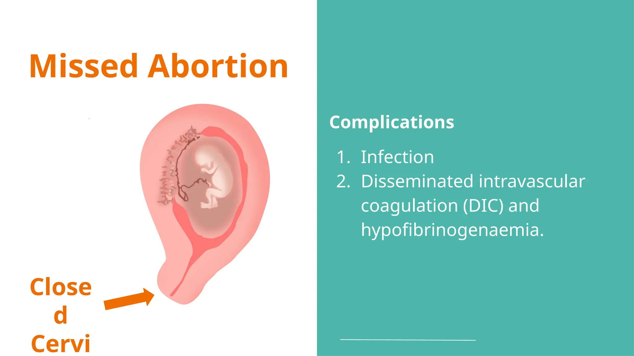 Missed Abortion
Close
d
Cervi
Complications
1. Infection
2. Disseminated intravascular
coagulation (DIC) and
hypofibrinogenaemia.
 