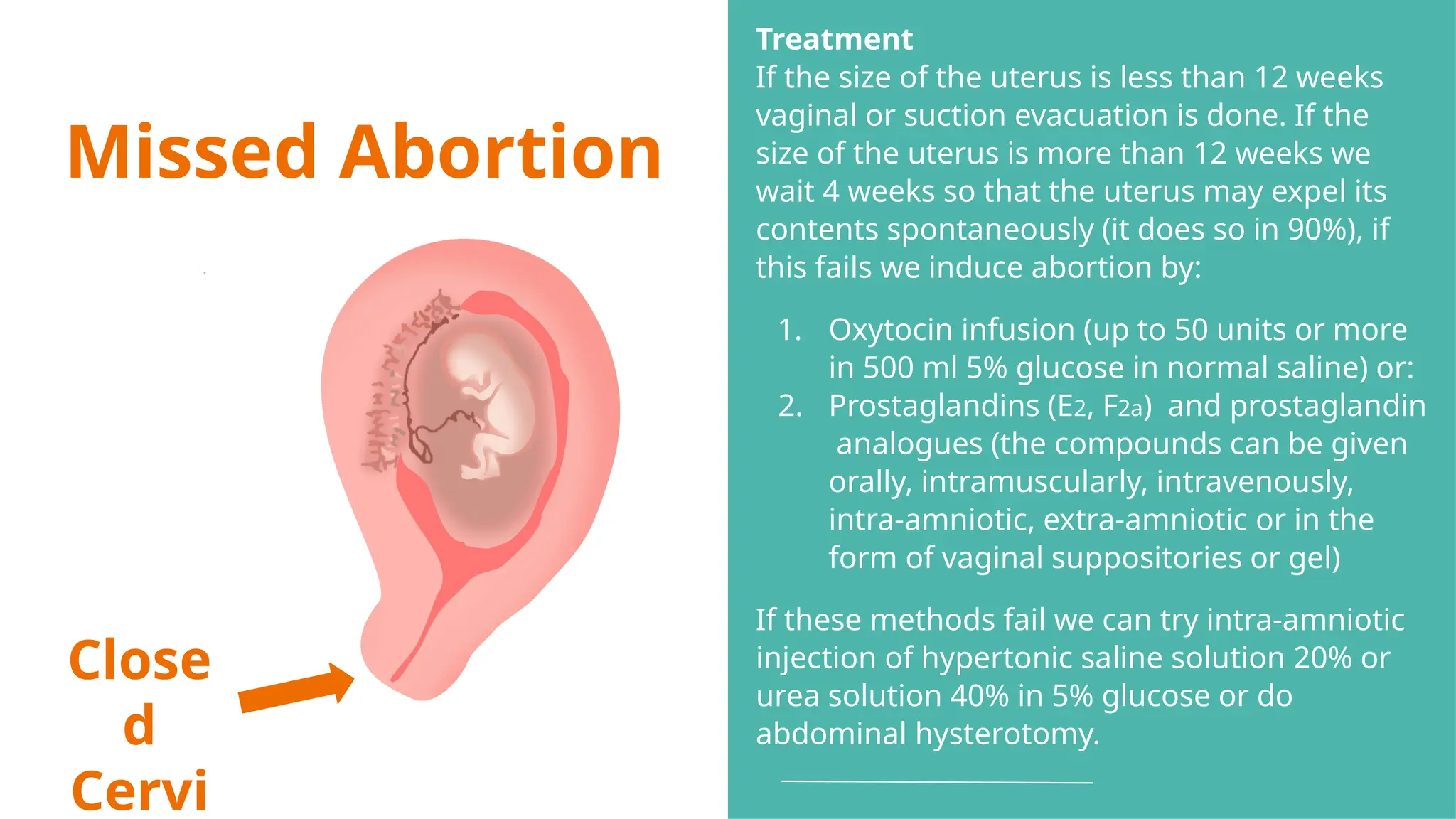 Missed Abortion
Close
d
Cervi
Treatment
If the size of the uterus is less than 12 weeks
vaginal or suction evacuation is done. If the
size of the uterus is more than 12 weeks we
wait 4 weeks so that the uterus may expel its
contents spontaneously (it does so in 90%), if
this fails we induce abortion by:
1. Oxytocin infusion (up to 50 units or more
in 500 ml 5% glucose in normal saline) or:
2. Prostaglandins (E2, F2a) and prostaglandin
analogues (the compounds can be given
orally, intramuscularly, intravenously,
intra-amniotic, extra-amniotic or in the
form of vaginal suppositories or gel)
If these methods fail we can try intra-amniotic
injection of hypertonic saline solution 20% or
urea solution 40% in 5% glucose or do
abdominal hysterotomy.
 