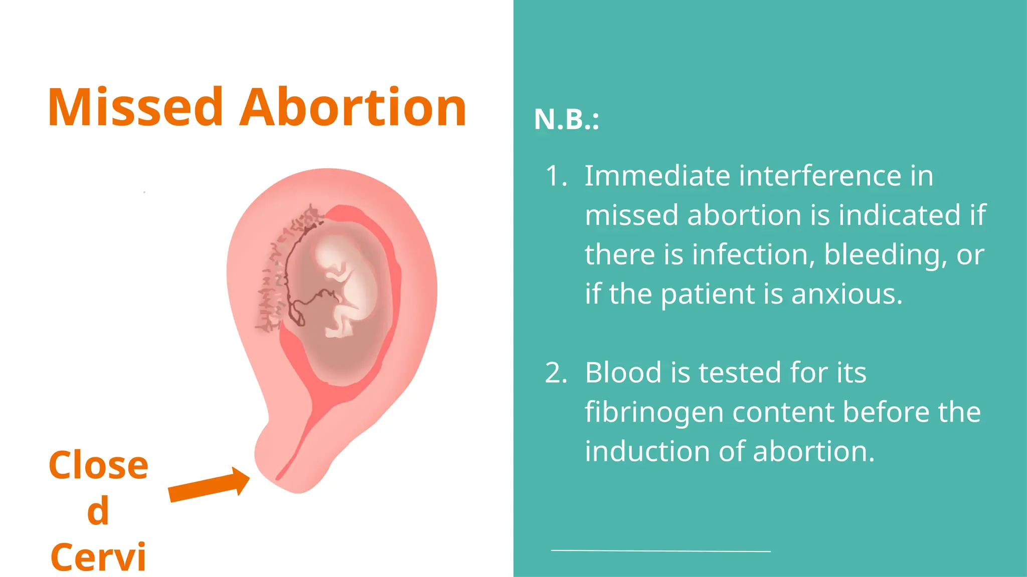 Missed Abortion
Close
d
Cervi
N.B.:
1. Immediate interference in
missed abortion is indicated if
there is infection, bleeding, or
if the patient is anxious.
2. Blood is tested for its
fibrinogen content before the
induction of abortion.
 