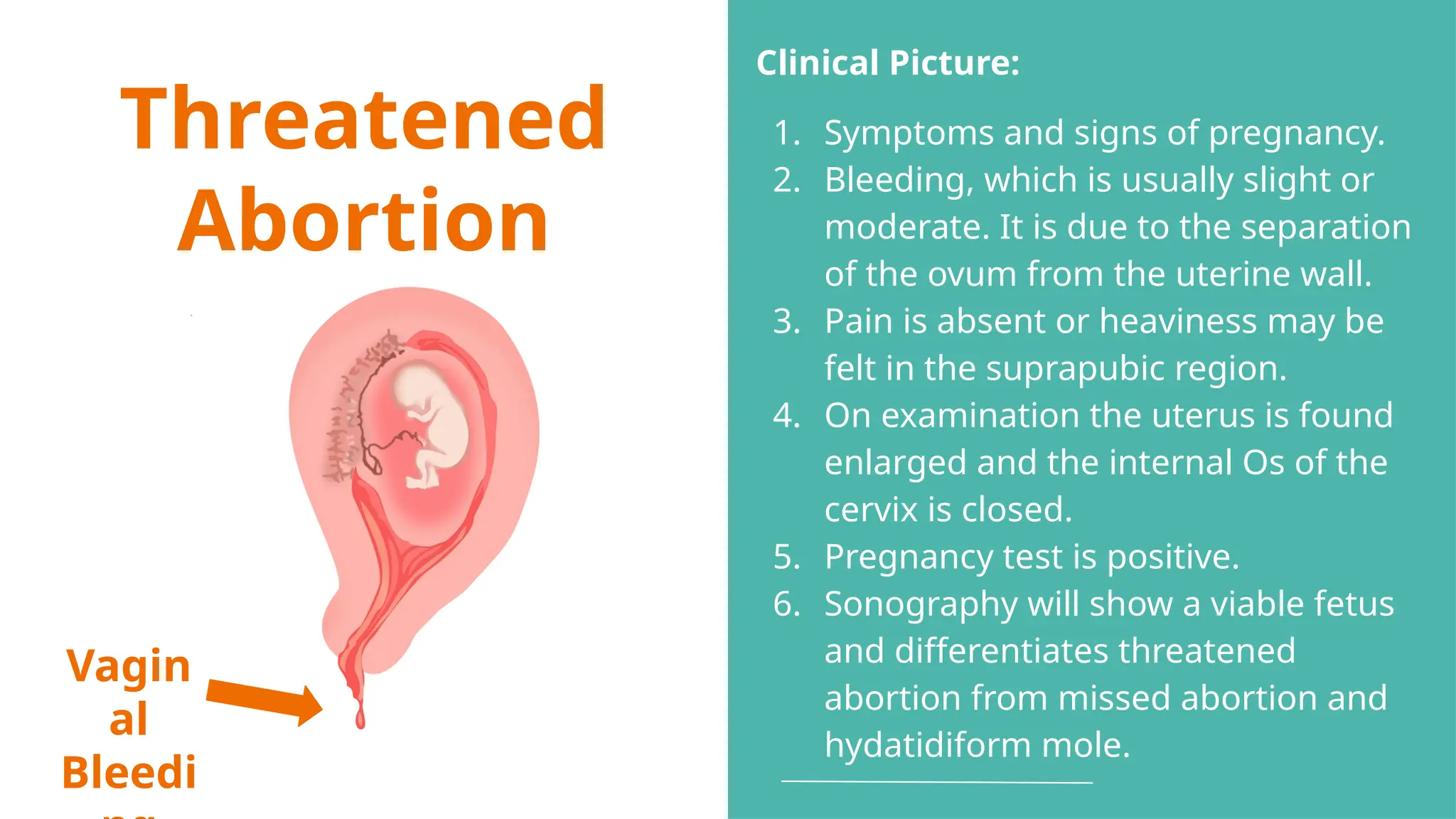 Threatened
Abortion
Vagin
al
Bleedi
Clinical Picture:
1. Symptoms and signs of pregnancy.
2. Bleeding, which is usually slight or
moderate. It is due to the separation
of the ovum from the uterine wall.
3. Pain is absent or heaviness may be
felt in the suprapubic region.
4. On examination the uterus is found
enlarged and the internal Os of the
cervix is closed.
5. Pregnancy test is positive.
6. Sonography will show a viable fetus
and differentiates threatened
abortion from missed abortion and
hydatidiform mole.
 