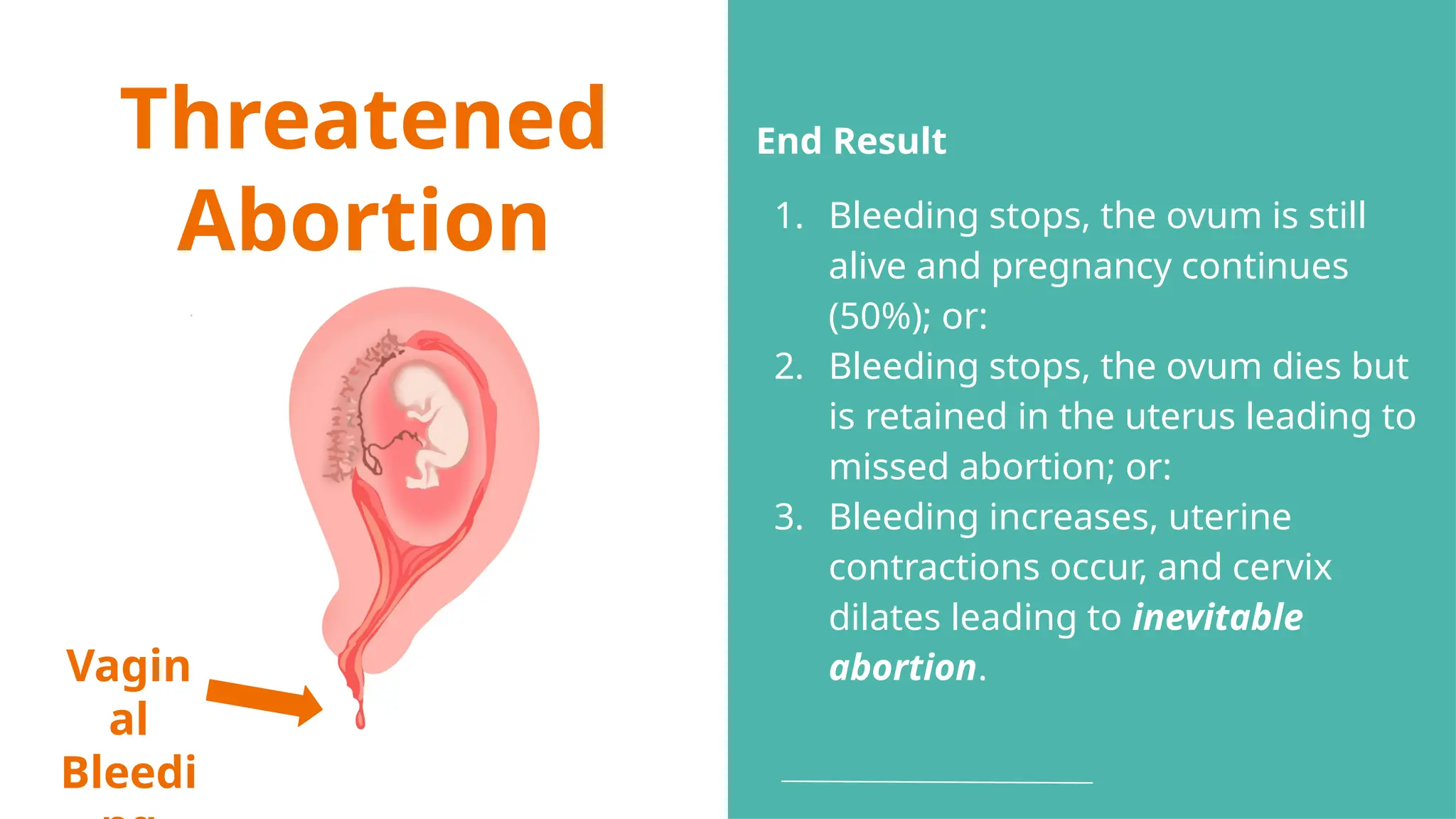 Threatened
Abortion
Vagin
al
Bleedi
End Result
1. Bleeding stops, the ovum is still
alive and pregnancy continues
(50%); or:
2. Bleeding stops, the ovum dies but
is retained in the uterus leading to
missed abortion; or:
3. Bleeding increases, uterine
contractions occur, and cervix
dilates leading to inevitable
abortion.
 