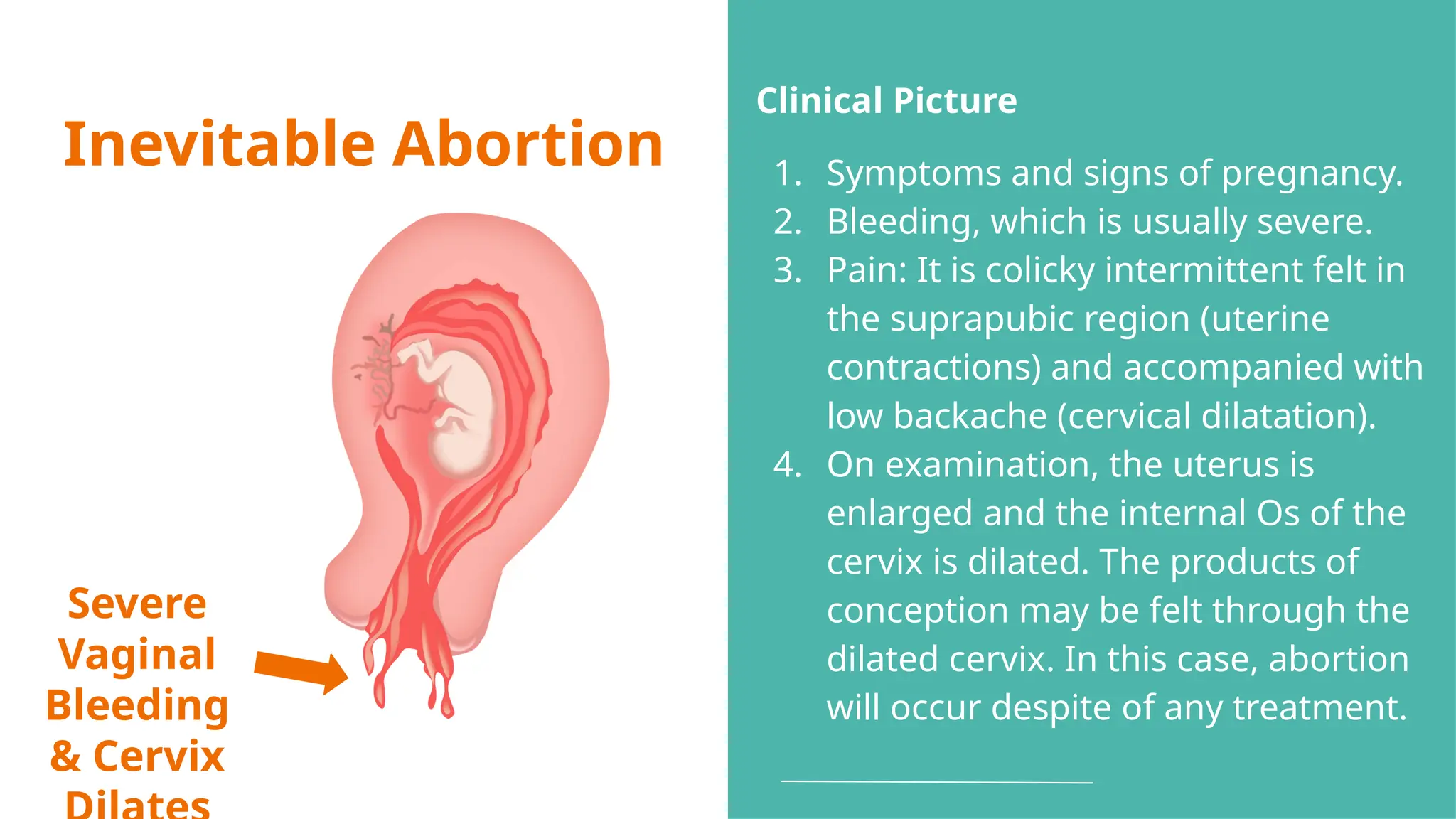 Inevitable Abortion
Severe
Vaginal
Bleeding
& Cervix
Clinical Picture
1. Symptoms and signs of pregnancy.
2. Bleeding, which is usually severe.
3. Pain: It is colicky intermittent felt in
the suprapubic region (uterine
contractions) and accompanied with
low backache (cervical dilatation).
4. On examination, the uterus is
enlarged and the internal Os of the
cervix is dilated. The products of
conception may be felt through the
dilated cervix. In this case, abortion
will occur despite of any treatment.
 