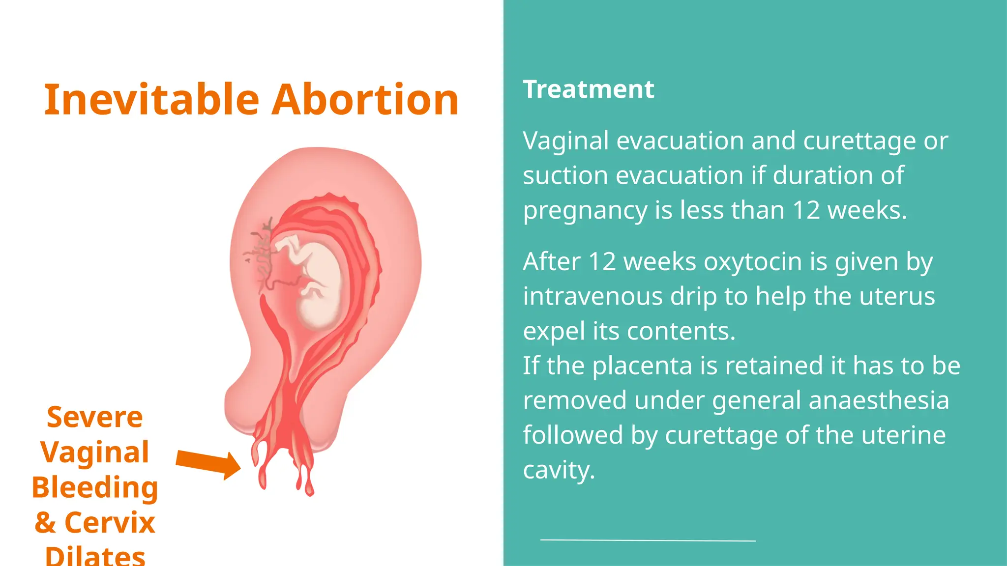 Inevitable Abortion
Severe
Vaginal
Bleeding
& Cervix
Treatment
Vaginal evacuation and curettage or
suction evacuation if duration of
pregnancy is less than 12 weeks.
After 12 weeks oxytocin is given by
intravenous drip to help the uterus
expel its contents.
If the placenta is retained it has to be
removed under general anaesthesia
followed by curettage of the uterine
cavity.
 