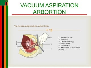VACUUM ASPIRATION
ARBORTION
75
 