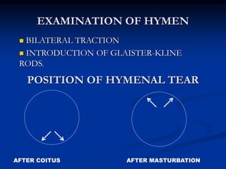 EXAMINATION OF HYMEN
 BILATERAL TRACTION
 INTRODUCTION OF GLAISTER-KLINE
RODS.
POSITION OF HYMENAL TEAR
AFTER COITUS AFTER MASTURBATION
 