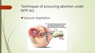 Abortion, infanticide | PPTX