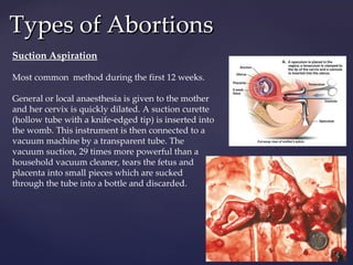 Types of Abortions Suction Aspiration Most common  method during the first 12 weeks. General or local anaesthesia is given to the mother and her cervix is quickly dilated. A suction curette (hollow tube with a knife-edged tip) is inserted into the womb. This instrument is then connected to a vacuum machine by a transparent tube. The vacuum suction, 29 times more powerful than a household vacuum cleaner, tears the fetus and placenta into small pieces which are sucked through the tube into a bottle and discarded. 