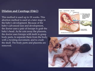 Dilation and Curettage (D&C) This method is used up to 18 weeks. This abortion method is used at a later stage in the baby’s development. Because of the baby’s advanced size and development, the doctor uses a pair of forceps to grab the baby’s head. As he cuts away the placenta, the doctor uses forceps with teeth to grasp body parts, to separate them from the body with a twisting movement, and to crush the skull. The body parts and placenta are removed. 