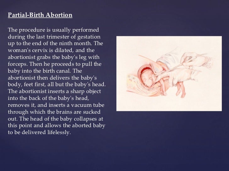 an analysis of the procedure of partial birth abortions If partial-birth abortion is too gruesome to allow, however, it is hard to see how other late abortions, especially d and es, are any different and that's the inevitable next target for pro-life . an analysis of the procedure of partial birth abortions If partial-birth abortion is too gruesome to allow, however, it is hard to see how other late abortions, especially d and es, are any different and that's the inevitable next target for pro-life .