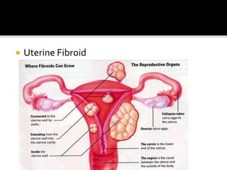  Uterine Fibroid
 