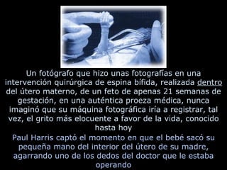 Un fotógrafo que hizo unas fotografías en una intervención quirúrgica de espina bífida, realizada  dentro  del útero materno, de un feto de apenas 21 semanas de gestación, en una auténtica proeza médica, nunca imaginó que su máquina fotográfica iría a registrar, tal vez, el grito más elocuente a favor de la vida, conocido hasta hoy Paul Harris captó el momento en que el bebé sacó su pequeña mano del interior del útero de su madre, agarrando uno de los dedos del doctor que le estaba operando 