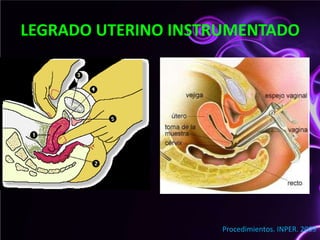 LEGRADO UTERINO INSTRUMENTADO                                   Procedimientos. INPER. 2009