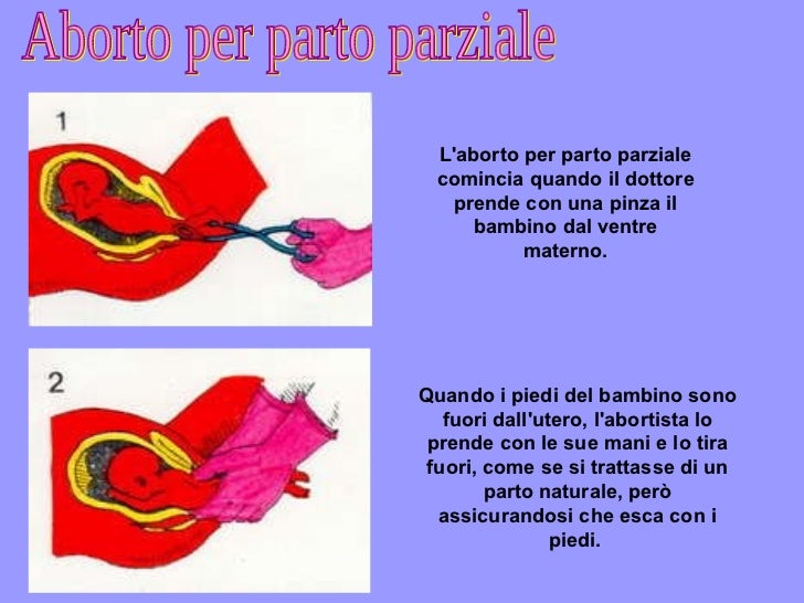 Sforzo Per Defecare E Aborto Aborto