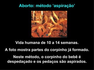 Vida humana de 10 a 14 semanas. A foto mostra partes do corpinho já formado. Neste método, o corpinho do bebê é despedaçado e os pedaços são aspirados. Aborto: método ‘aspiração’ 