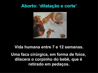Vida humana entre 7 e 12 semanas. Uma faca cirúrgica, em forma de foice,  dilacera o corpinho do bebê, que é  retirado em pedaços. Aborto: ‘dilatação e corte’ 