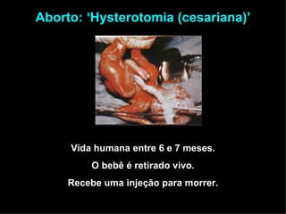 Vida humana entre 6 e 7 meses. O bebê é retirado vivo. Recebe uma injeção para morrer. Aborto: ‘Hysterotomia (cesariana)’ 
