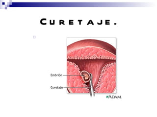 Curetaje. 
