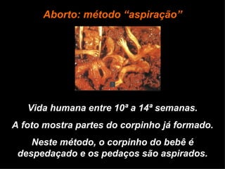 Vida humana entre 10ª a 14ª semanas. A foto mostra partes do corpinho já formado. Neste método, o corpinho do bebê é despedaçado e os pedaços são aspirados. Aborto: método “aspiração” 