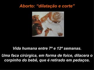Vida humana entre 7ª e 12ª semanas. Uma faca cirúrgica, em forma de foice, dilacera o corpinho do bebê, que é retirado em pedaços. Aborto: “dilatação e corte” 
