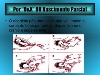 Por “D&X” OU Nascimento Parcial O abortista põe uma pinça que vai tirando o corpo do bébé por partes, depois tira-se o crânio e suga-se este. 