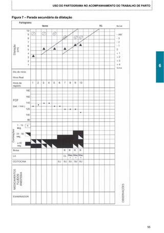 USO DO PARTOGRAMA NO ACOMPANHAMENTO DO TRABALHO DE PARTO



Figura 7 – Parada secundária da dilatação




                                                                                      6




                                                                                 55
 