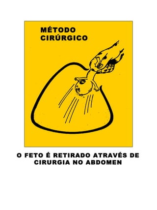 MÉTODO
     CIRÚRGICO




O FETO É RETIRADO ATRAVÉS DE
    CIRURGIA NO ABDOMEN
 