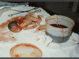 Aborto