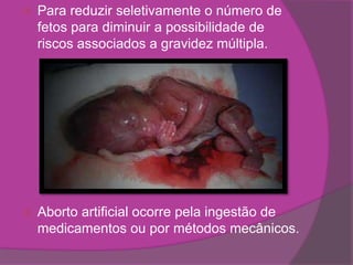    Para reduzir seletivamente o número de
    fetos para diminuir a possibilidade de
    riscos associados a gravidez múltipla.




   Aborto artificial ocorre pela ingestão de
    medicamentos ou por métodos mecânicos.
 