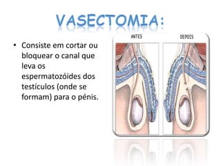 • Consiste em cortar ou
  bloquear o canal que
  leva os
  espermatozóides dos
  testículos (onde se
  formam) para o pénis.
 